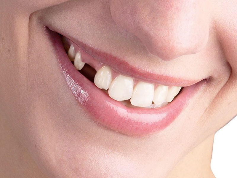 Eksik dişler, ağız ve dil kanserine yol açabilir