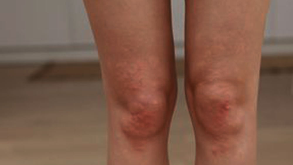 Bacaklardaki kırmızı noktaların nedenleri...