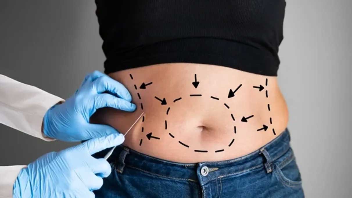 Uzmanı açıkladı! Liposuction nedir kimler yaptırabilir?