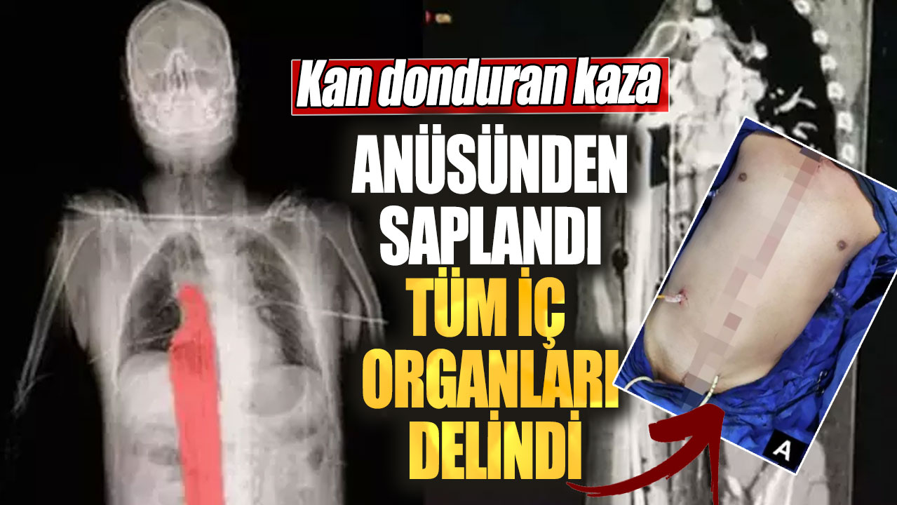 Anüsünden saplandı tüm iç organları delindi. Kan donduran kaza