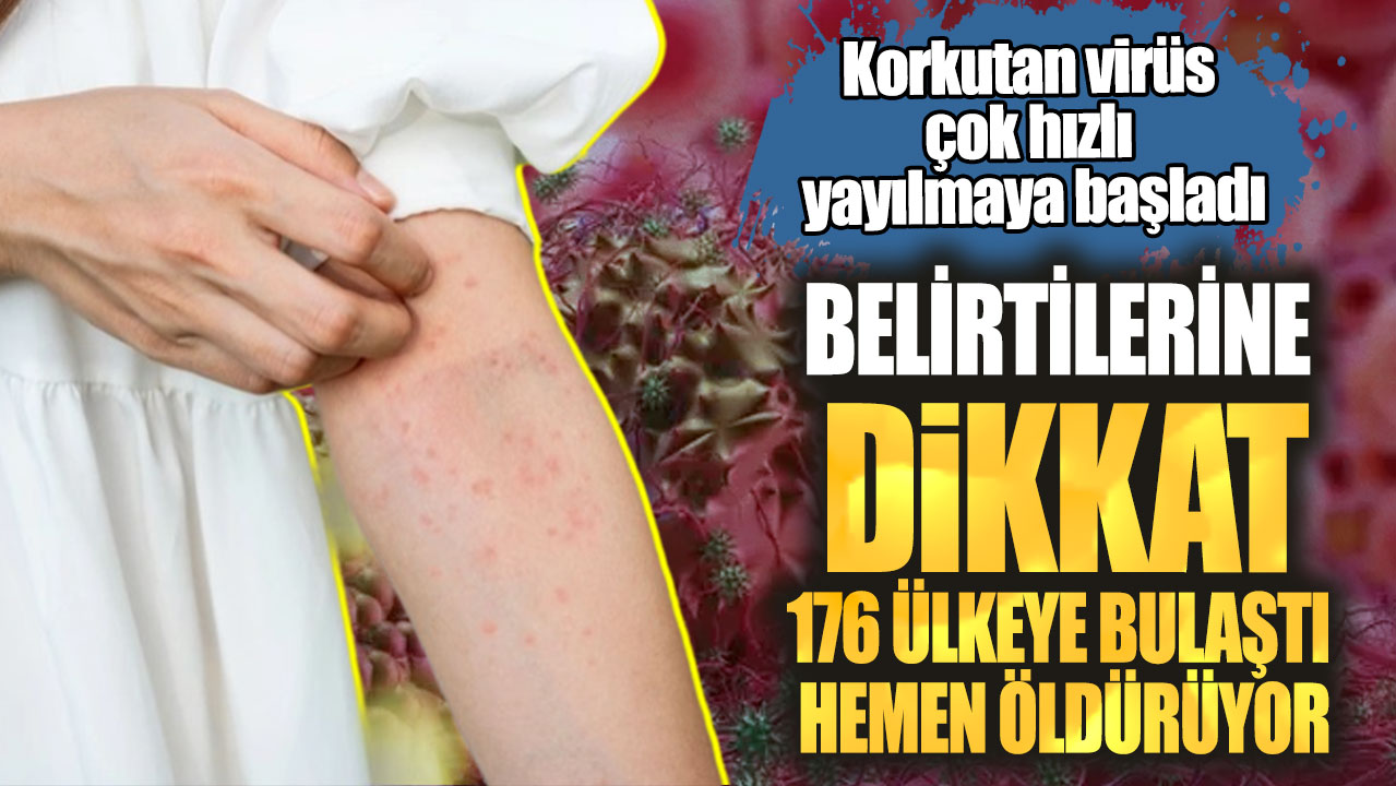 Korkutan virüs çok hızlı yayılmaya başladı. Belirtilerine dikkat 176 ülkeye bulaştı hemen öldürüyor