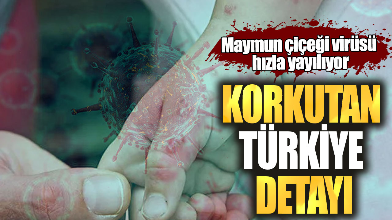 Maymun çiçeği virüsü hızla yayılıyor! Korkutan Türkiye detayı