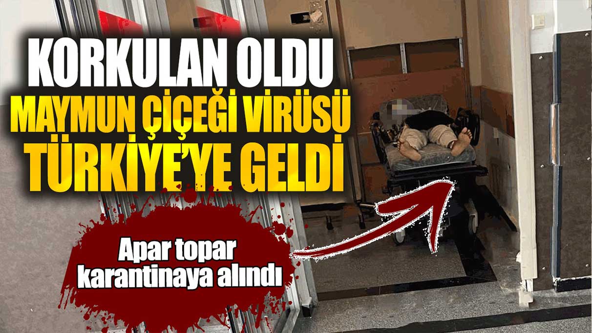 Korkulan oldu Maymun çiçeği virüsü Türkiye’ye geldi! Apar topar karantinaya alındı