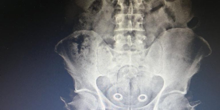 Kars'ta bağırsağındaki uyuşturucu röntgende ortaya çıktı
