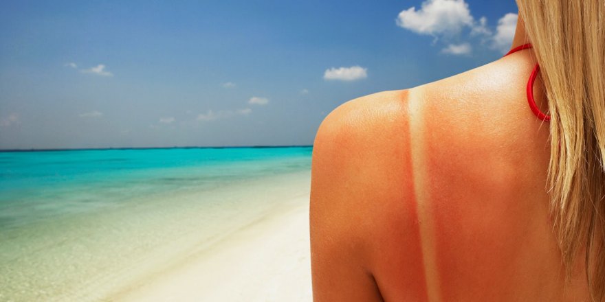 Tatilciler dikkat: Güneş yanığına kesinlikle bunları sürmeyin