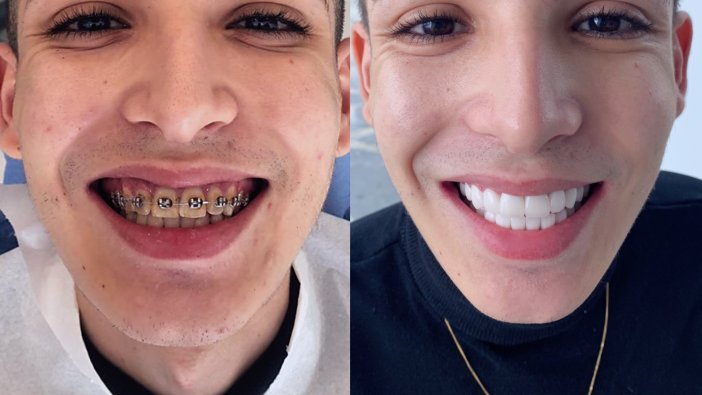 Yabancı turistlerden diş estetiğinde ‘Hollywood Smile' ilgisi