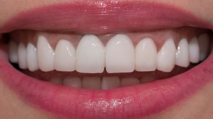 İşte Zirkonyum diş kaplamasının avantajları