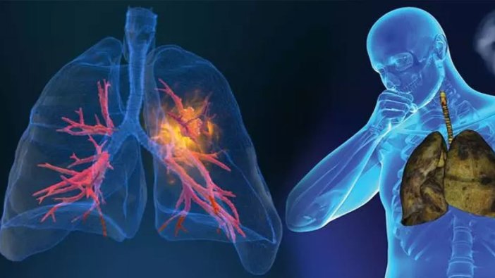 Akciğer kanseri nedir? Belirtiler nelerdir?