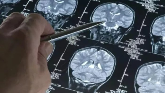 Alzheimer hastalığında görülen ilk belirti! 14 yıl önce bulundu