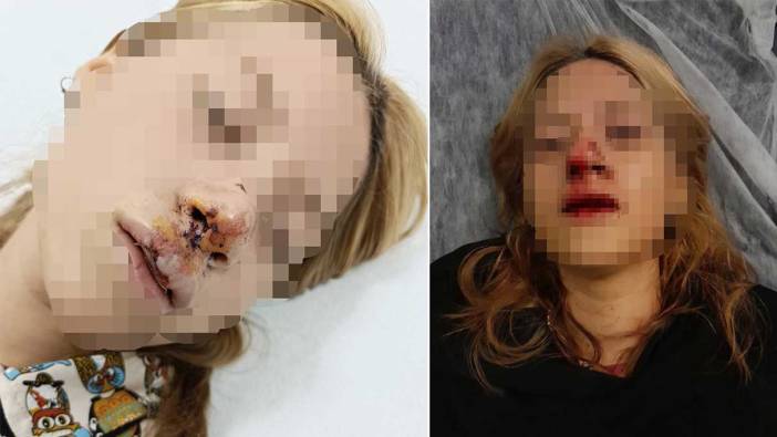 Sultangazi'de kaldırım taşıyla genç kızın yüzünü yaralayan şüpheli yakalandı
