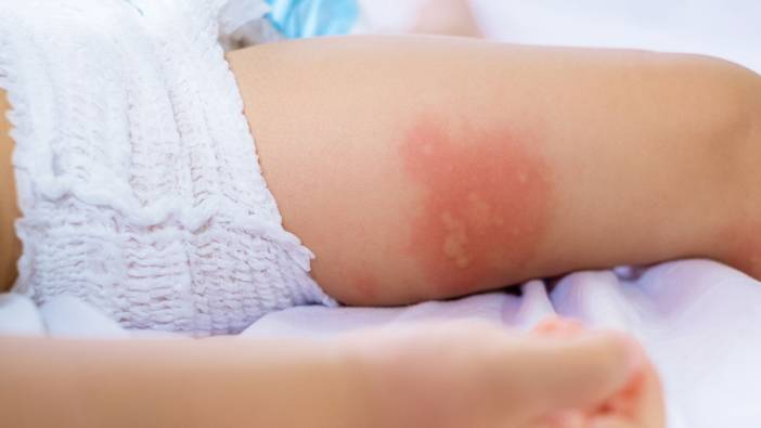 Uzman isim uyardı! Besin alerjisi çocukları etkiliyor