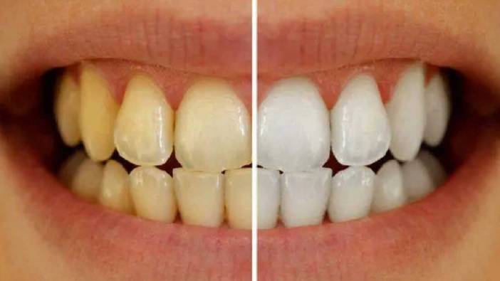 Dişlerinizdeki sararmalara doğal çözüm bu kadar basit