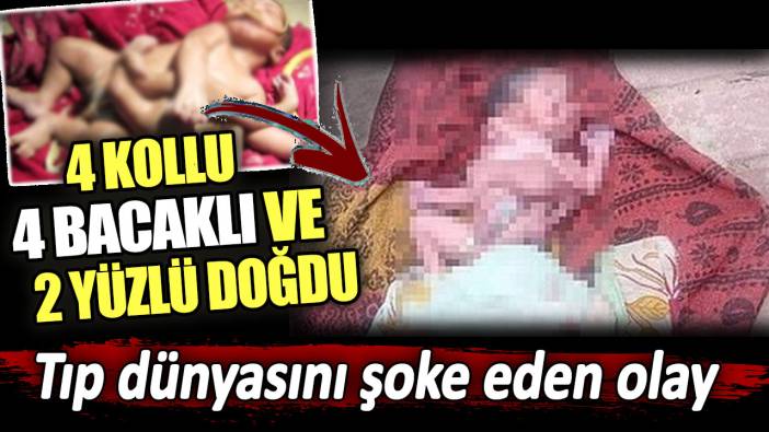 Tıp dünyasını şoke eden olay. 4 kollu 4 bacaklı ve 2 yüzlü doğdu