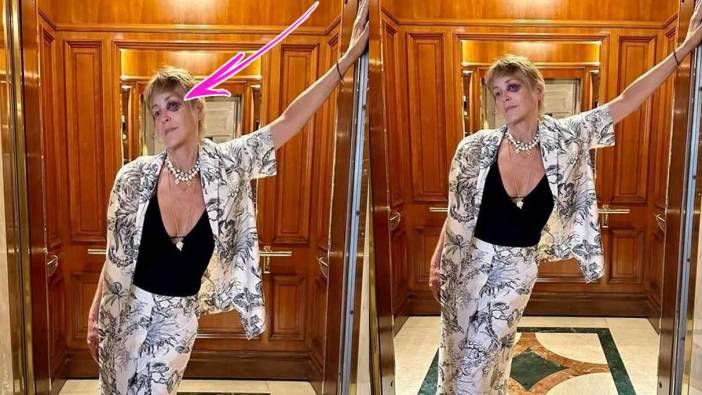 Sharon Stone'un gözü mosmor oldu. Sebebini açıkladı