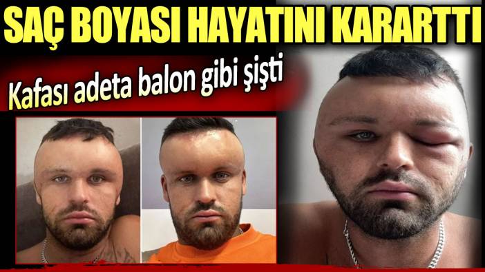 Saçını boyayan adamın kafası büyüdü