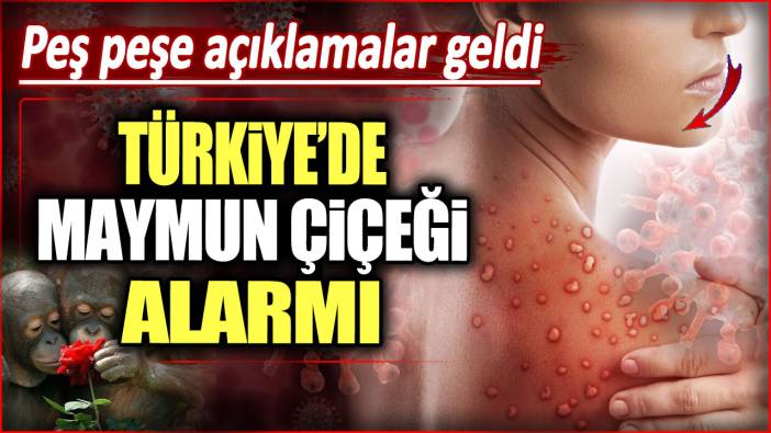 Türkiye’de Maymun Çiçeği alarmı. Peş peşe açıklamalar geldi