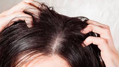Kepeğe karşı etkili saç bakım önerileri