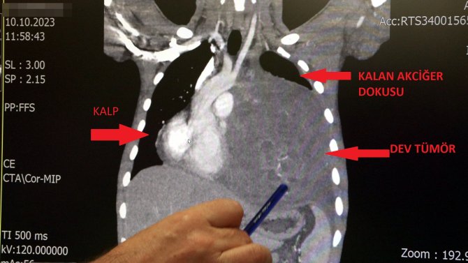 kalbini-12-santim-saga-kaydiran-6-5-kiloluk-dev-tumor-doktorlarini-bile-sasirtti-5937-dhaphoto3.jpg