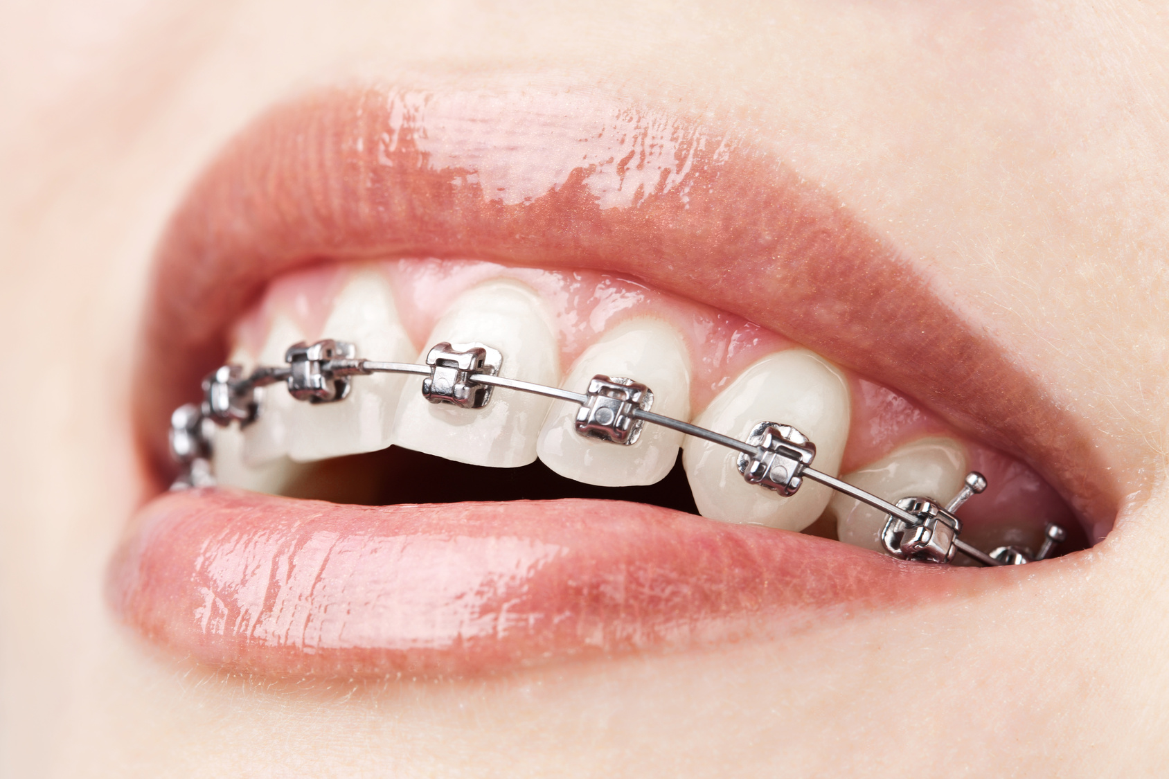 dis-teli-ortodonti-tedavisi.jpg